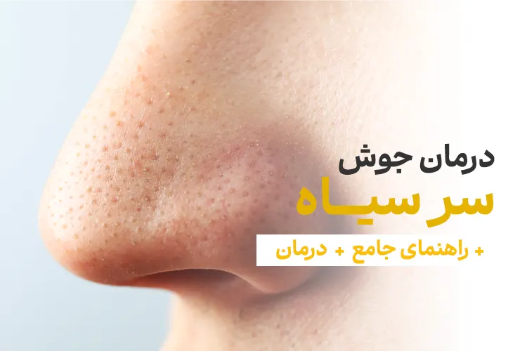 درمان جوش سر سیاه + 5 روش درمان خانگی جوش سر سیاه