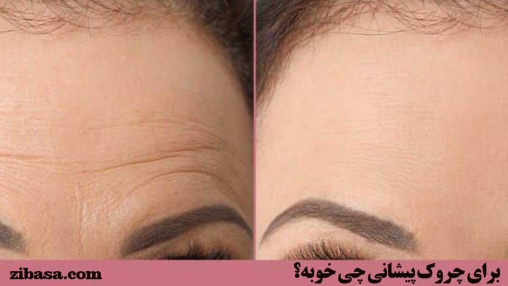 برای چروک پیشانی چی خوبه؟- تصویر مقایسه دو پیشانی زن سمت چپ با چروک و سمت راست بعد از استفاده از کرم ضد چروک پیشانی