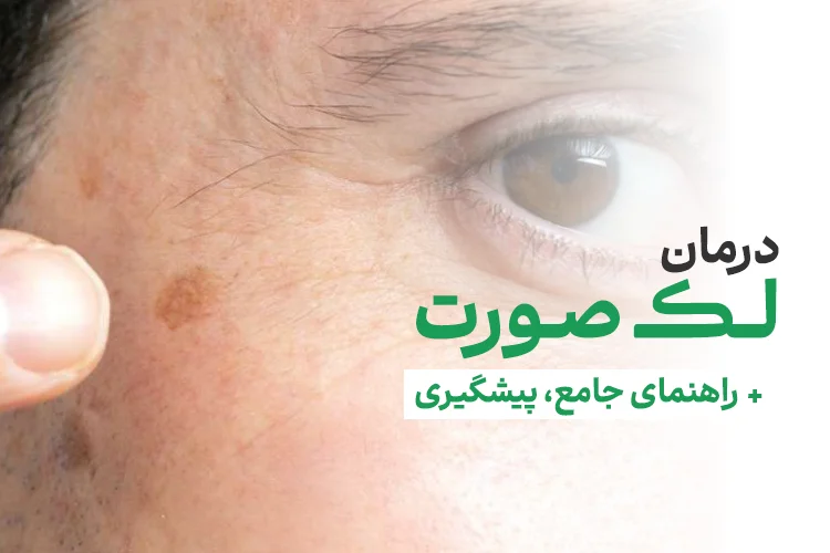 درمان لک صورت